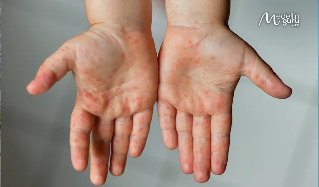 Example of skin lesions reported by swimmers after visiting Santa Marta Beach