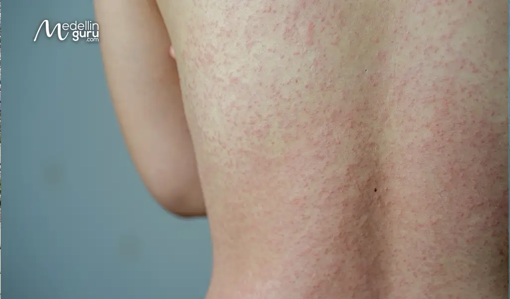 Skin allergies highlighting concerns about water quality